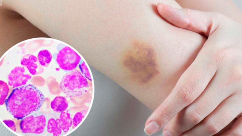 Los diagnósticos de leucemia en Tamaulipas muestran un aumento de hasta el 300%