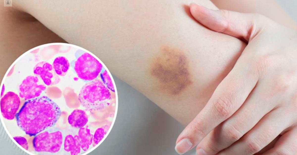 Los diagnósticos de leucemia en Tamaulipas muestran un aumento de hasta el 300%