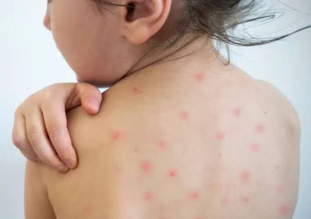 «Detectado el Primer Caso de Sarampión en Hospital Infantil de México