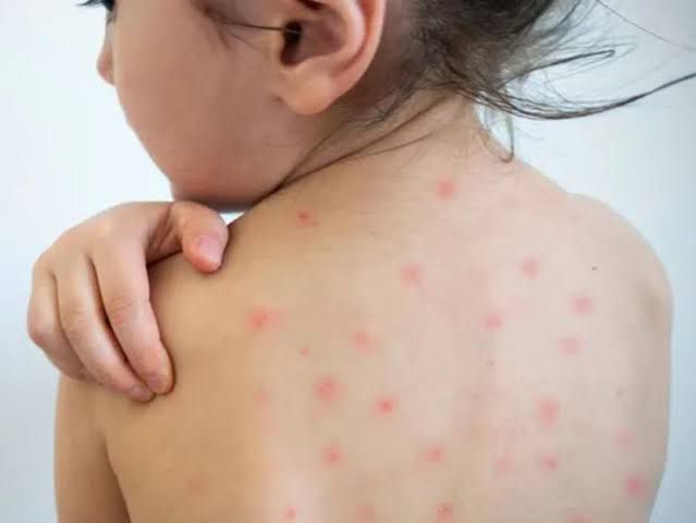 «Detectado el Primer Caso de Sarampión en Hospital Infantil de México