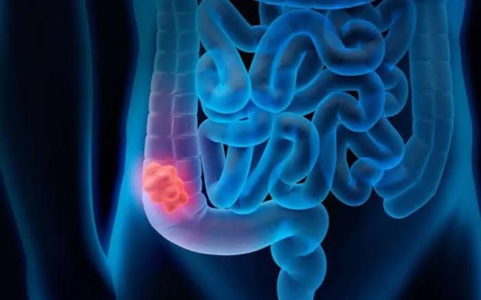 Aumento alarmante de casos de cáncer colorrectal en jóvenes: UNAM alerta sobre la importancia del diagnóstico temprano