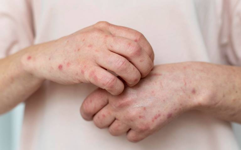 Secretaría de Salud emite nueva alerta epidemiológica por casos de sarampión en México