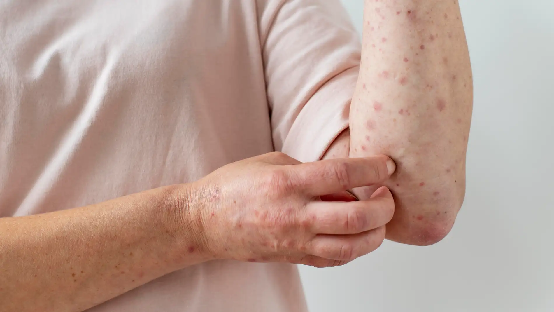 Tamaulipas en alerta ante posibles casos de sarampión