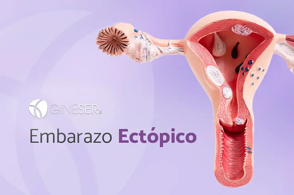 Embarazo ectópico: causas, síntomas y tratamiento temprano para evitar complicaciones graves