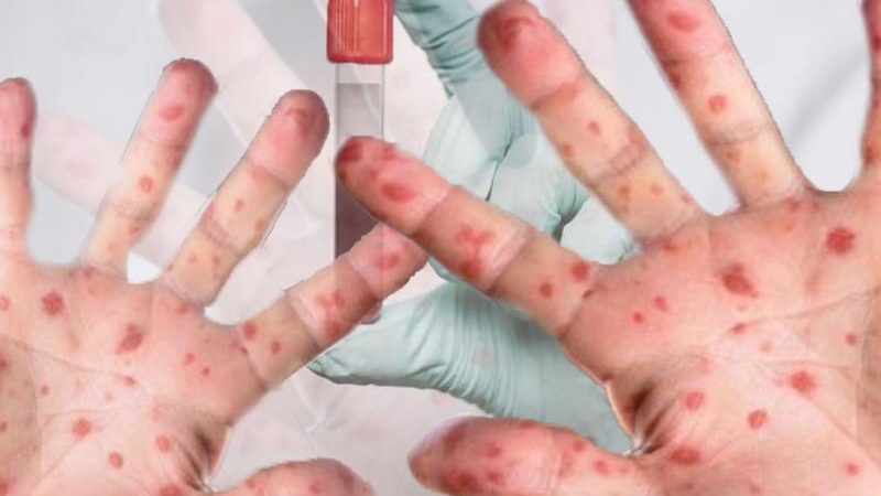 Tamaulipas Acumula 32 Casos de Viruela Símica desde 2020, Refuerzan Medidas de Prevención