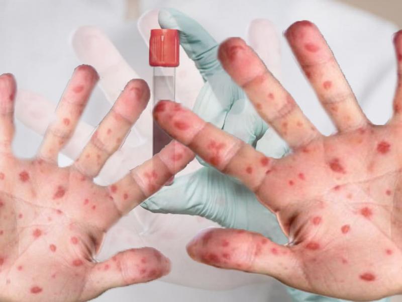 Tamaulipas Acumula 32 Casos de Viruela Símica desde 2020, Refuerzan Medidas de Prevención